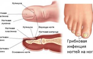 Что такое микоз ногтей?