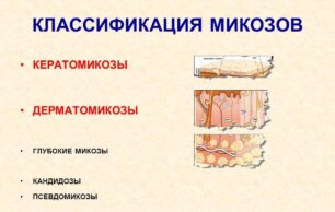 Симптомы и лечение микоза гладкой кожи