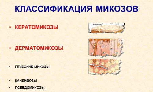 Симптомы и лечение микоза гладкой кожи