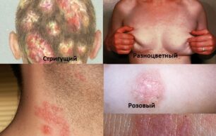 Симптомы и причины: от чего появляется лишай?