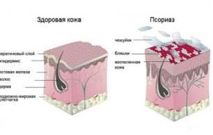 Диагностирован каплевидный псориаз: лечение традиционными и народными способами