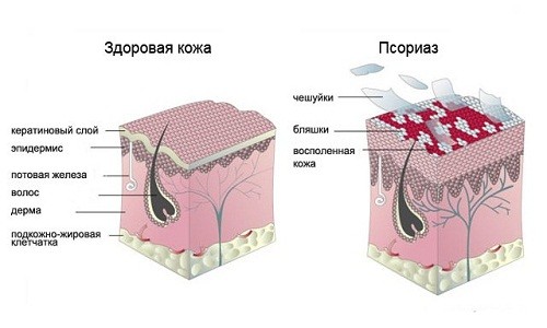 Диагностирован каплевидный псориаз: лечение традиционными и народными способами