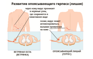 Какие мази применяются при опоясывающем лишае?