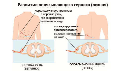 Какие мази применяются при опоясывающем лишае?